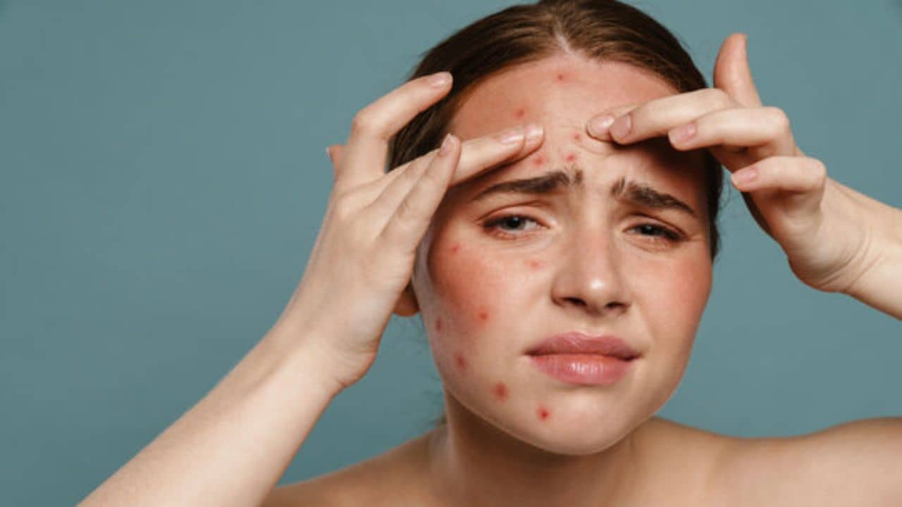 Acne Prevention: ব্রণর সমস্যায় জর্জরিত? ভরসা রাখুন কয়েকটি সাধারণ উপায়ে