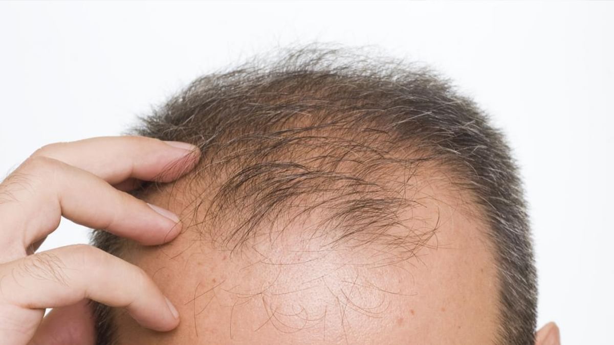 Hair Fall Problem: চুল পড়া বন্ধ করবেন কীভাবে?