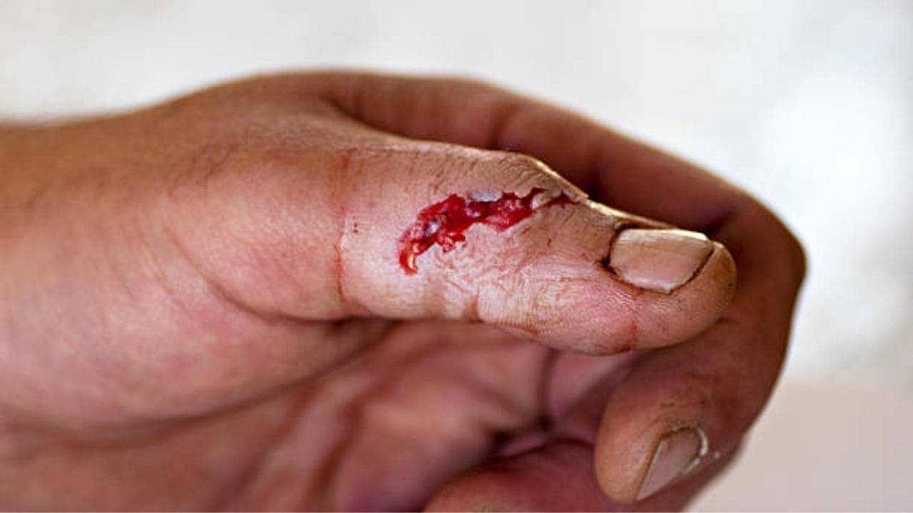 Wound: জং ধরা ছুড়িতে আঙুল কেটে গিয়েছে? প্রাথমিক করণীয় কী, রইল টিপস