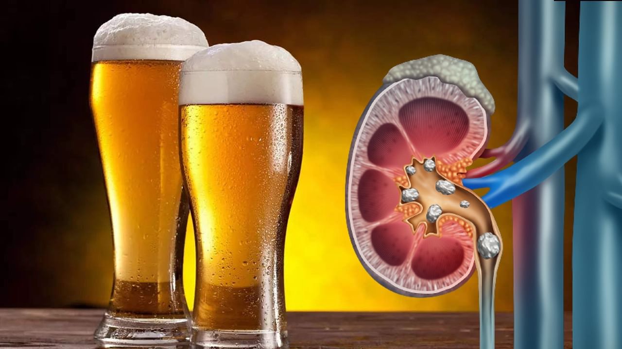 Kidney Stone বিয়ারে গলবে কিডনির পাথর Bengali News Drinking beer