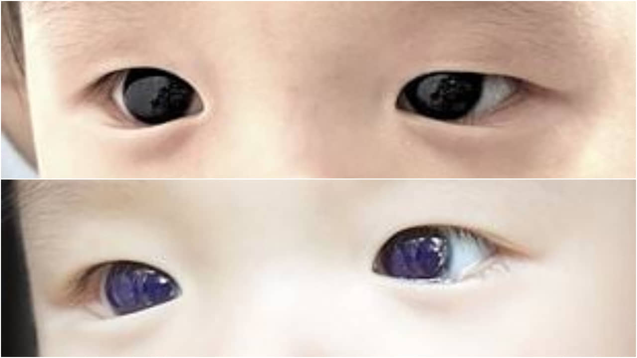 Thailand: কোভিডের চিকিৎসার জেরে শিশুর বাদামি চোখ হয়ে গেল নীল! ধাঁধায় বিজ্ঞানীরা