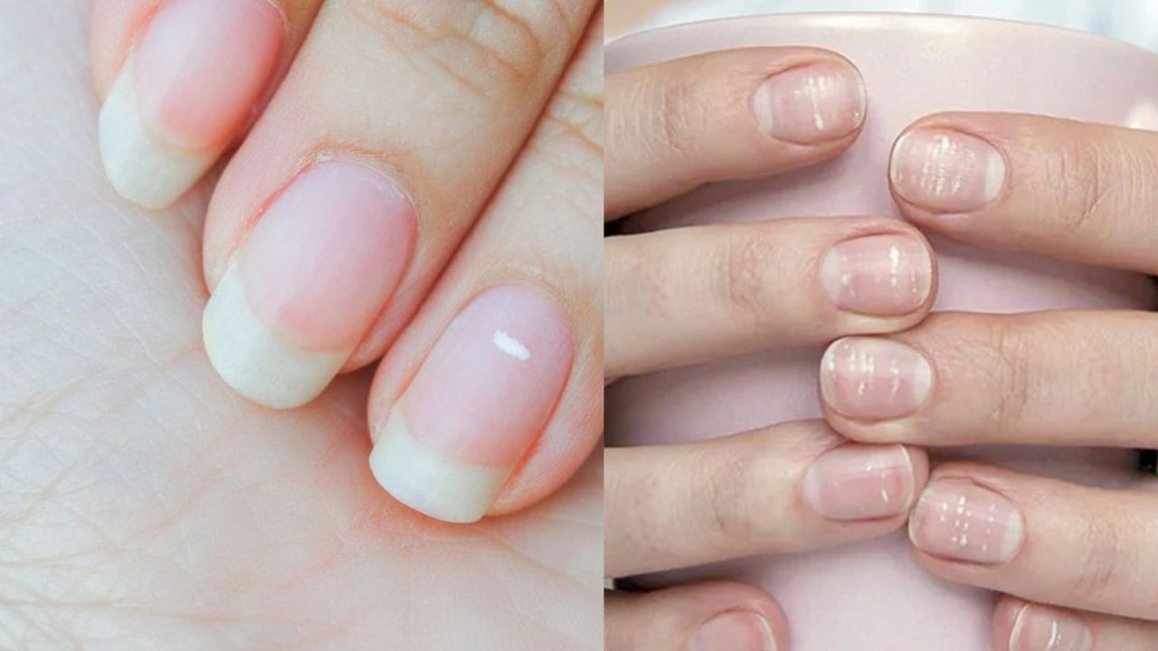 Worried About White Spots On Fingernails? | Andrew Weil, M.D.