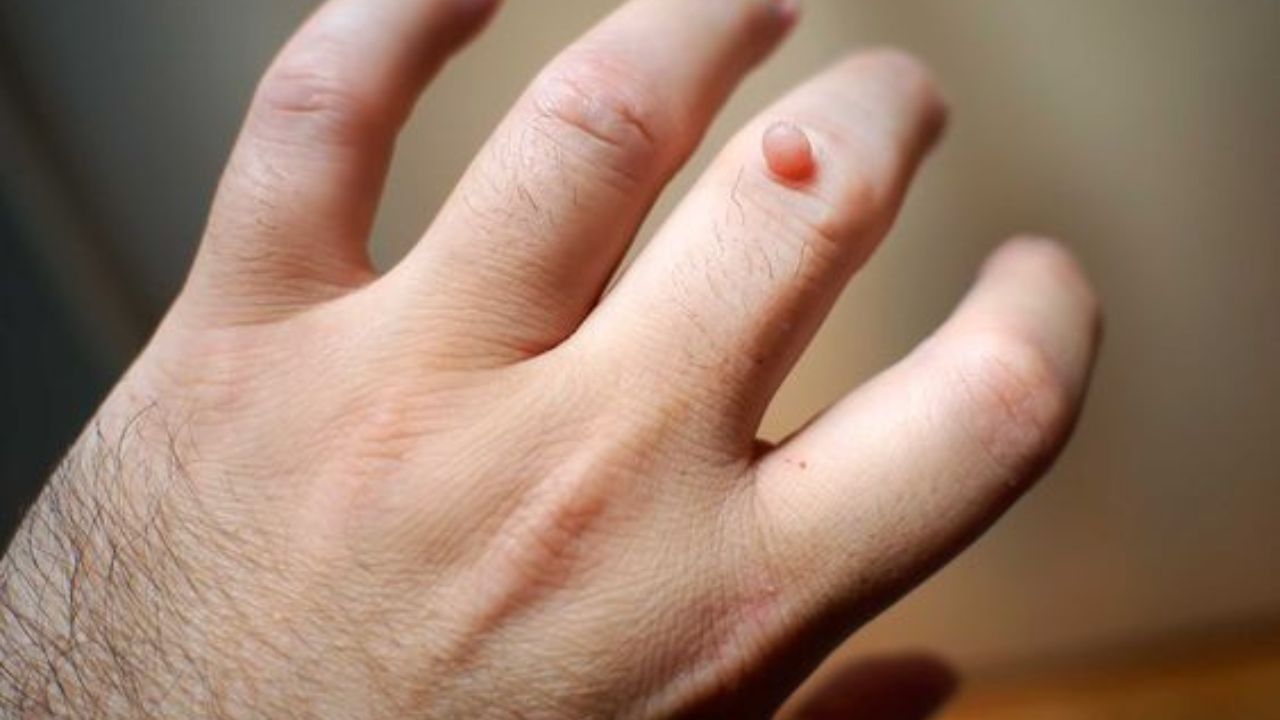 এছাড়া ব্যবহার করতে পারেন ভিটামিন ই। এই ভিটামিন আঁচিলের সমস্যা থেকে মুক্তি দিতে সক্ষম। এক্ষেত্রে ব্য়বহার করতে হবে ভিটামিন ই ক্যাপসুল। আঁচিলযুক্ত স্থানে এই ক্য়াপসুলের নির্যাস লাগালেই কাজ হবে।