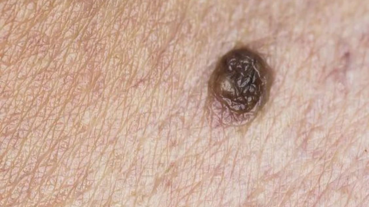 তাই আপনার চাই এমন কিছু যা প্রাকৃতিকভাবে এই আঁচিলের সমস্য়া থেকে আপনাকে মুক্তি দিতে পারবে। জানুন তার জন্য় কী করতে হবে...