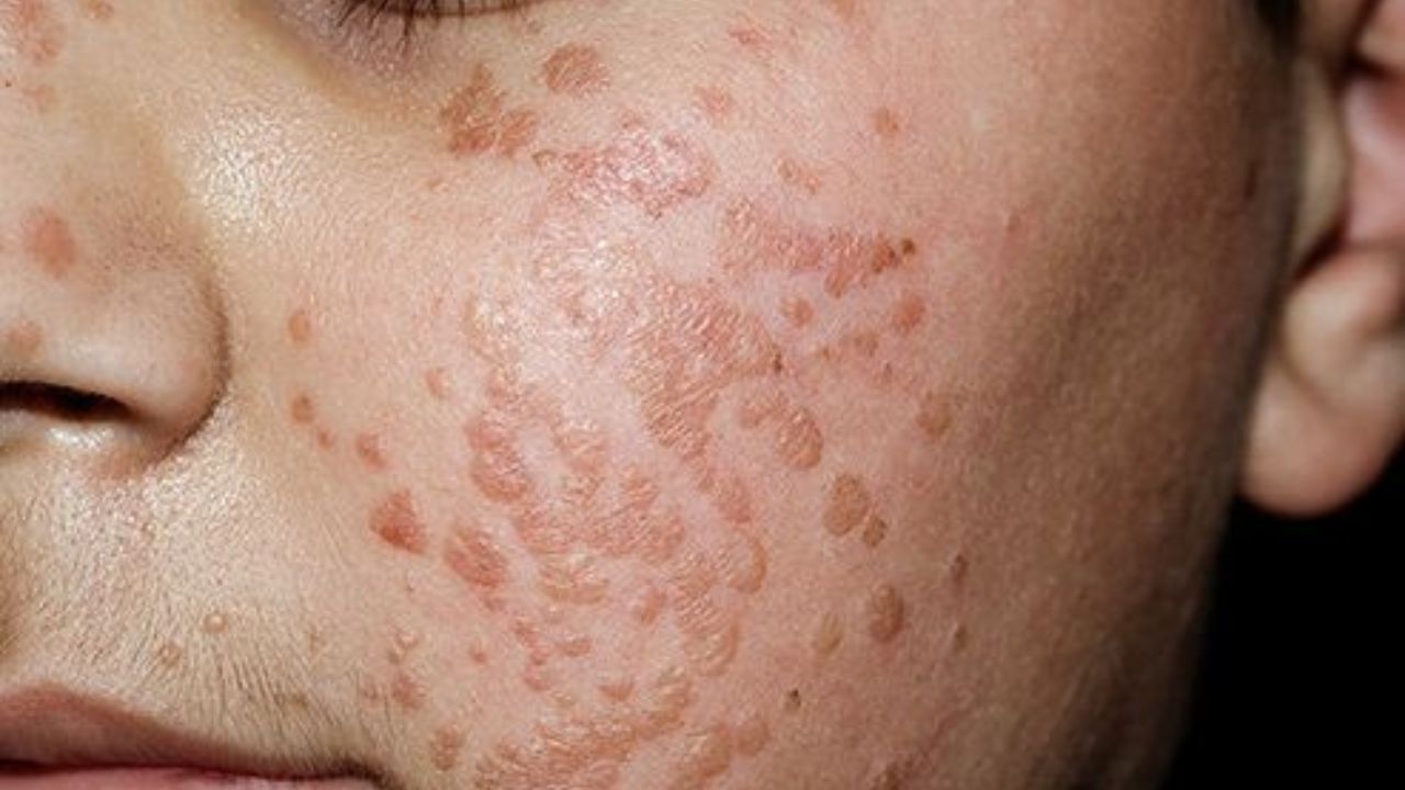 আর নইলে লেজর ট্রিটমেন্ট করিয়ে আঁচিল অপসারণ করা। যা অনেকসময়ই ব্যয়সাপেক্ষ হয়ে দাঁড়ায়। শুধু তাই-ই নয়, ত্বকের জন্য এই চিকিৎসা কতটা ভাল তা নিয়েও বিস্তর মতবিরোধ রয়েছে।