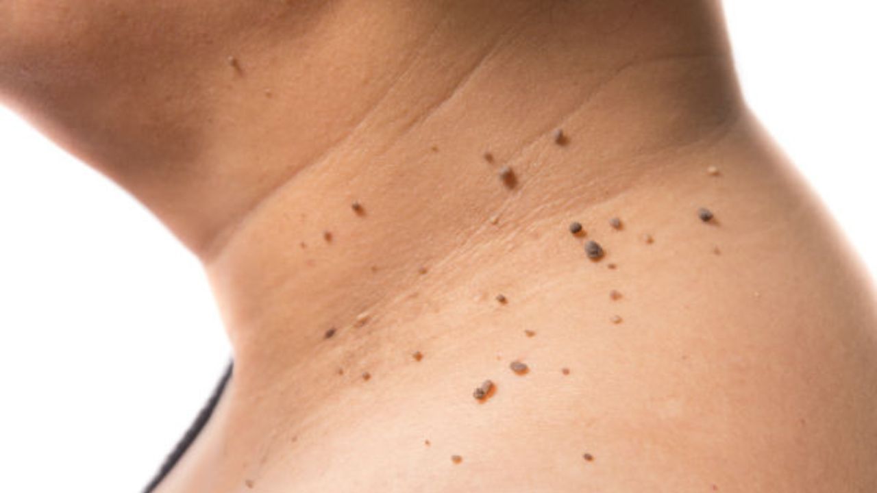 এই আঁচিলের সমস্য়ার স্থায়ী কোনও সমাধান নেই। চিকিৎসা বলতে এক ধমরনের ওষুধ পাওয়া যায় যা খেলে বা লাগালে অনেকসময়ই কোনও কাজের কাজ হয় না।