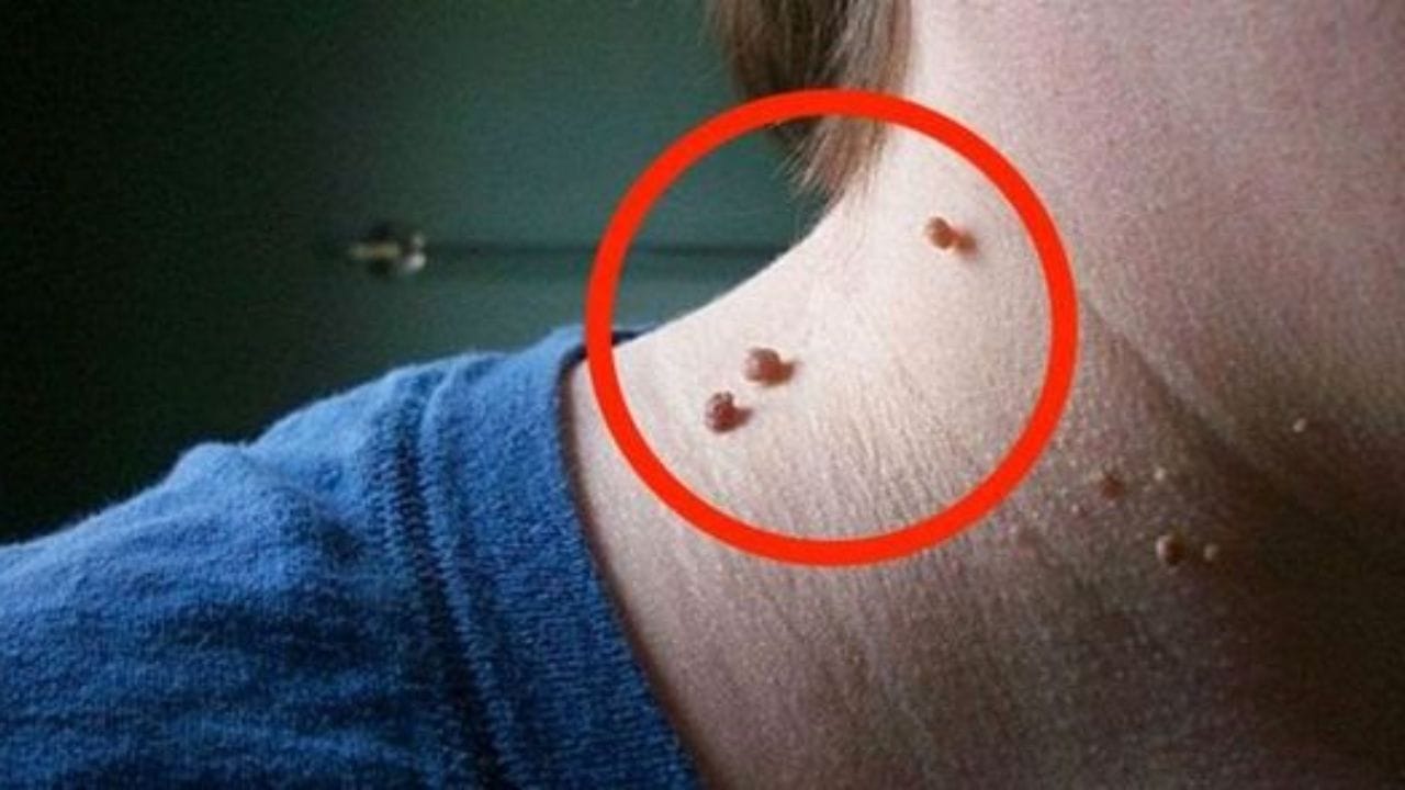 খেয়াল করে দেখেবেন অনেকেরই গোটা গায়ে বিভিন্ন জায়গায় আঁচিল থাকে। যা দেখতে মোটেই ভাল দেখায় না। এর জন্য কী করবেন জানা আছে?