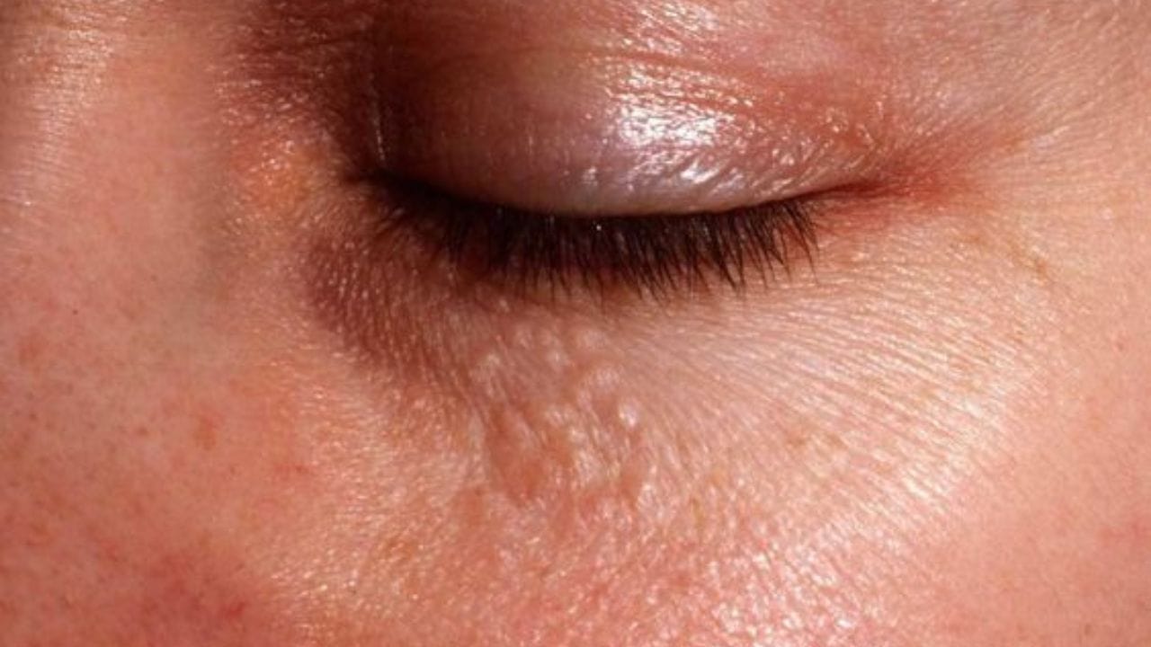 আঁচিলের সমস্যা থেকে বাঁচতে আরও ব্যবহার করতে পারেন ক্যাস্টর অয়েলও। এতে কয়েকদিনের মধ্য়েই আঁচিল গায়েব হবে। দিনে দু'বার আঁচিলযুক্ত স্থানে এই তেল লাগান। ফল পাবেন হাতেনাতে।