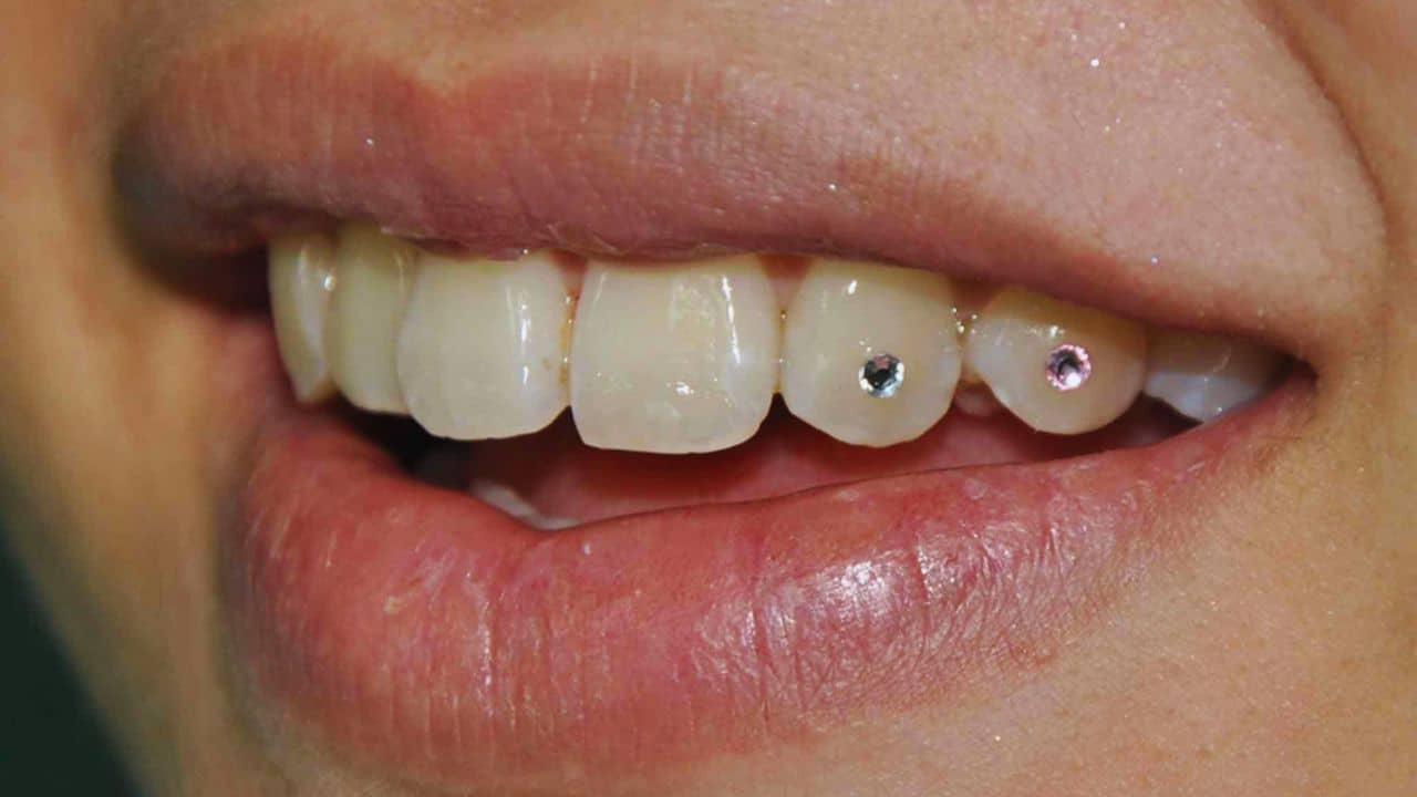 Diamond in Teeth: পুজোয় ৩২ পাটি দাঁতে হিরে বসালেন যুবতী, খরচ কত জানেন?