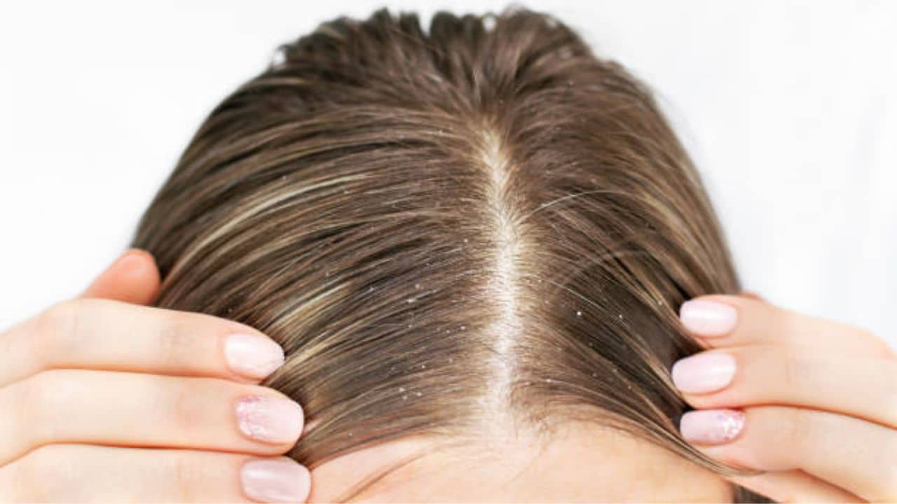 Dandruff Prevent: জাঁকিয়ে ঠান্ডা পরার আগেই খুশকিকে রুখে দিন, সাহায্য নিন এই ৩ উপাদানের