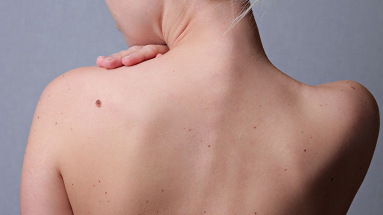 আঁচিলের রং কালো হলে যা শুভ ও অশুভ ফল দেয়। যদিও শরীরে লাল রঙের তিল থাকা শুভ ও ফলদায়ক। লাল তিল সম্পদ, সমৃদ্ধি এবং সুখের প্রাপ্তি নির্দেশ করে। শরীরে কোথায় তিল থাকলে তা অশুভ, তা জেনে নিন এখানে…