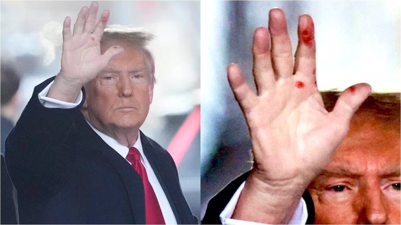 Donald Trump: যৌনরোগে ভুগছেন ডোনাল্ড ট্রাম্প? হাতের তালু জুড়ে রহস্যময় দাগ...