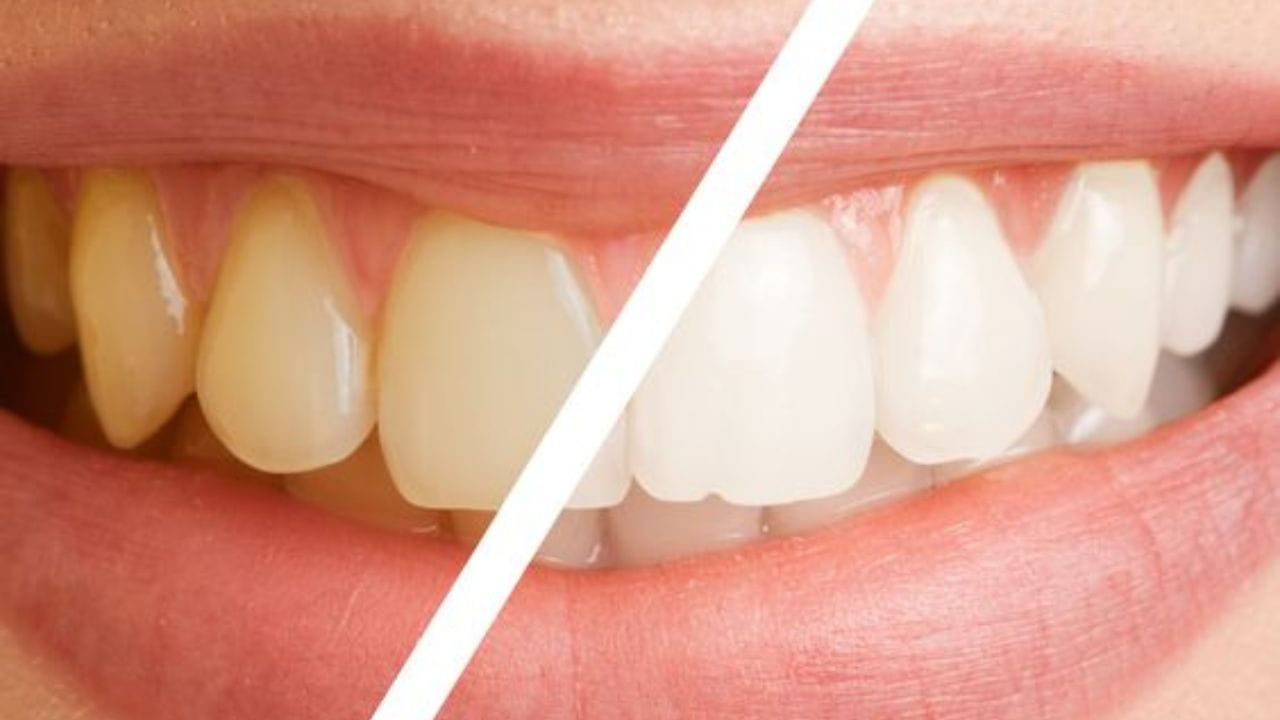 অনেকের দাঁতে হলুদ ছোপ দেখা যায়। যা মুখের সৌন্দর্য নষ্ট করে। ধূমপানসহ বিভিন্ন কারণে এই সমস্যা হতে পারে। এই সমস্যা থেকে মুক্তির কোনও উপায় আছে কি? (ছবি:Pinterest)