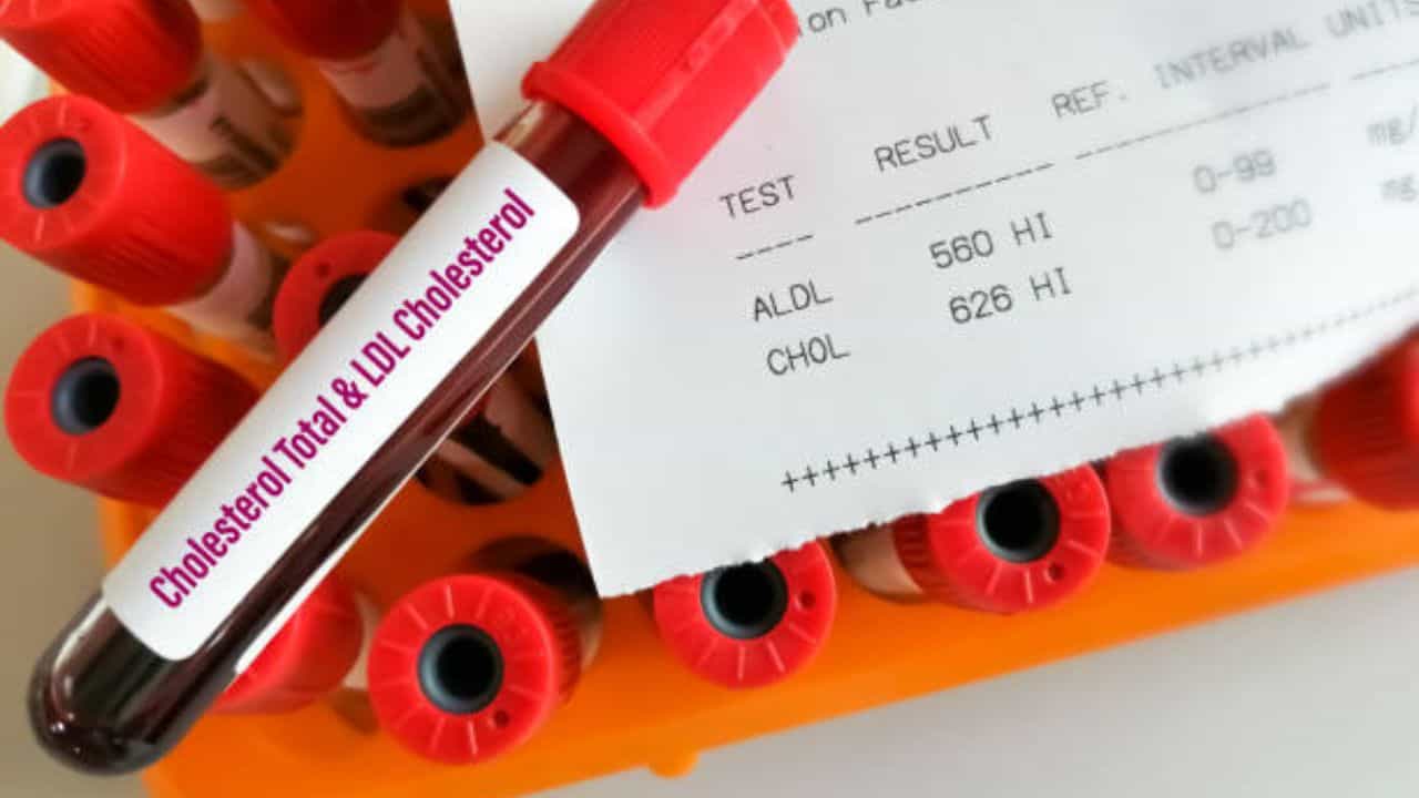 কোন বয়সে হার্ট অ্যাটাক হচ্ছে, তার পিছনে কারণ হিসেবে রয়েছে কোলেস্টেরল কোন বয়সে হার্ট অ্যাটাক হচ্ছে, তার পিছনে কারণ হিসেবে রয়েছে কোলেস্টেরল