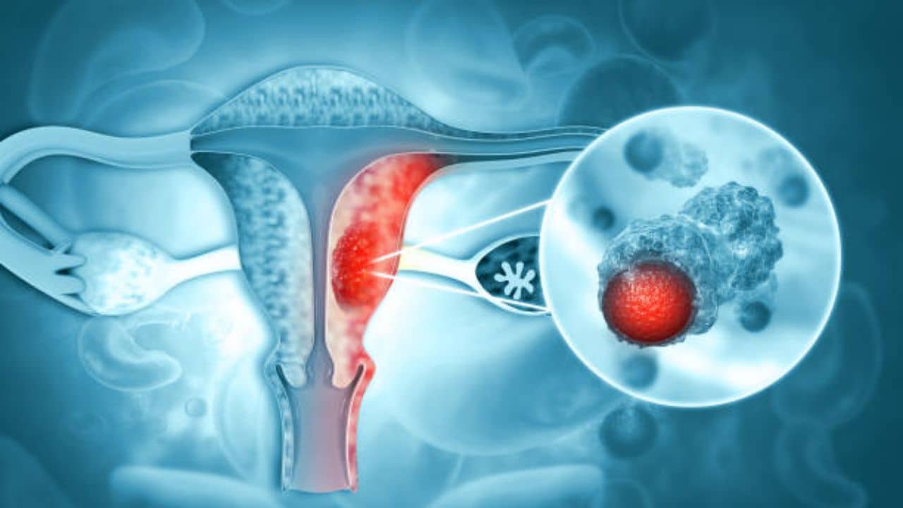 Cervical Cancer: সচেতনতার অভাবেই কি মহিলাদের মধ্যে বাড়ছে জরায়ু ক্যানসার? কোন লক্ষণে প্রথমেই সচেতন হবেন