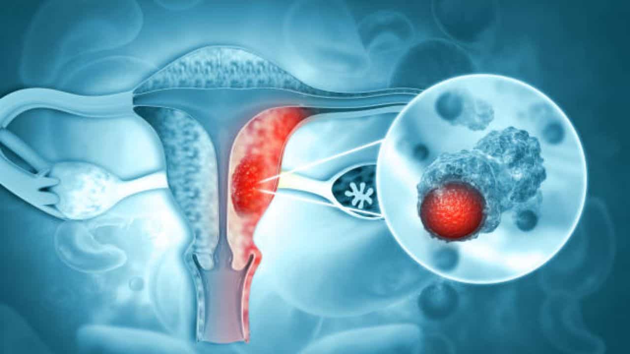 Cervical Cancer: সচেতনতার অভাবেই কি মহিলাদের মধ্যে বাড়ছে জরায়ু ক্যানসার? কোন লক্ষণে প্রথমেই সচেতন হবেন Cervical Cancer: সচেতনতার অভাবেই কি মহিলাদের মধ্যে বাড়ছে জরায়ু ক্যানসার? কোন লক্ষণে প্রথমেই সচেতন হবেন