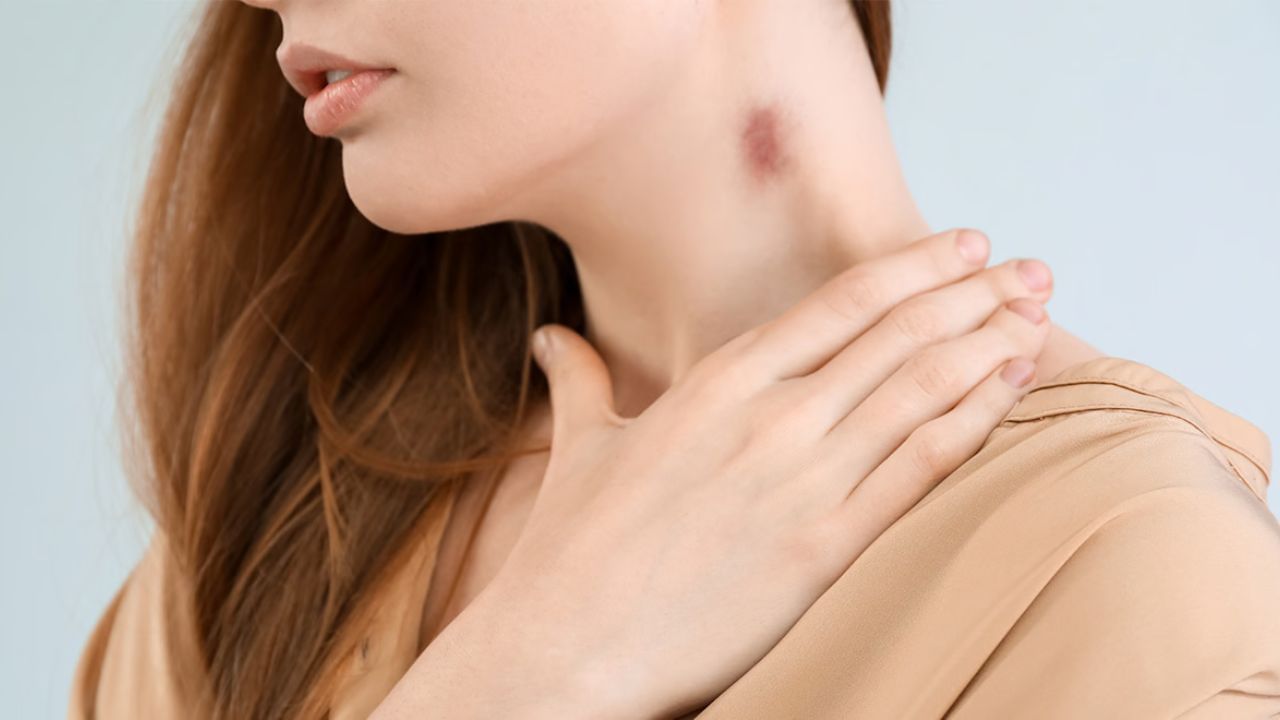 গলায় ভালবাসার চিহ্ন? এই ৪ টোটকায় ঢেকে ফেলুন হিকি গলায় ভালবাসার চিহ্ন? এই ৪ টোটকায় ঢেকে ফেলুন হিকি