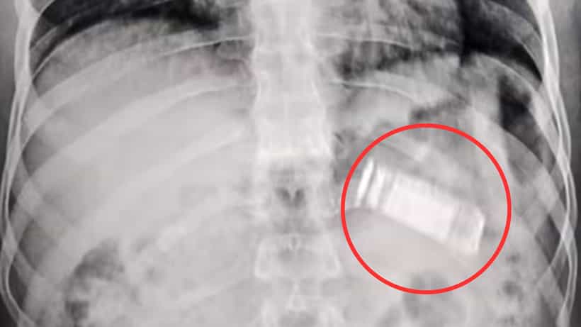 Mobile in stomach: পেটের ভিতর আস্ত মোবাইল দেখে চোখ কপালে ডাক্তারদের, বের করা হল মুখ দিয়ে
