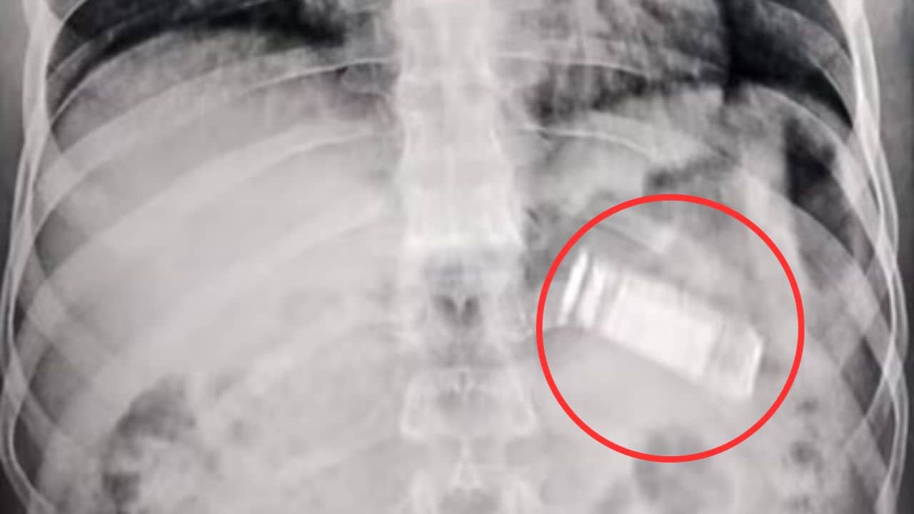 Mobile in stomach: পেটের ভিতর আস্ত মোবাইল দেখে চোখ কপালে ডাক্তারদের, বের করা হল মুখ দিয়ে