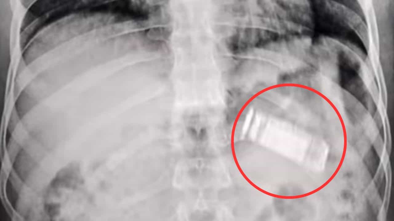 Mobile in stomach: পেটের ভিতর আস্ত মোবাইল দেখে চোখ কপালে ডাক্তারদের, বের করা হল মুখ দিয়ে Mobile in stomach: পেটের ভিতর আস্ত মোবাইল দেখে চোখ কপালে ডাক্তারদের, বের করা হল মুখ দিয়ে