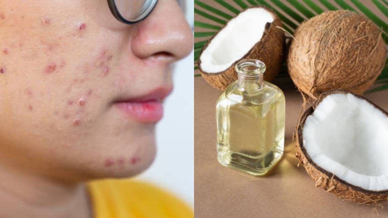 ব্রণ তাড়াতে নারকেল তেল মাখা কি ঠিক? ভুল জানলে নিজের ক্ষতি করে বসবেন