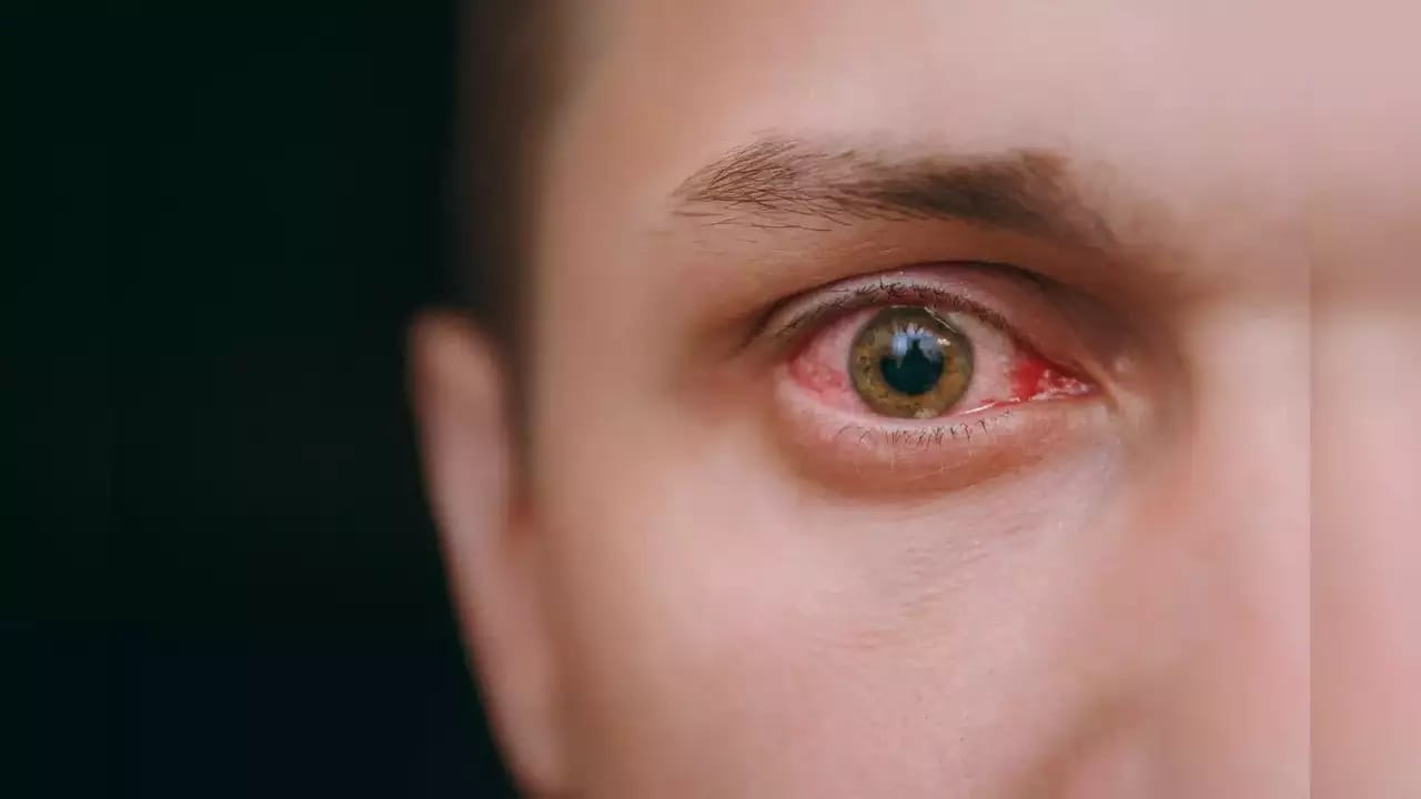 আর সেই সব কিছুকে এড়িয়ে চললে মারাত্মক ইনফেকশনও হয়ে যেতে পারে। মেকআপ করার পরে লেন্স পরবেন না। আগে লেন্স পরে তারপরেই মেকআপ করুন। 