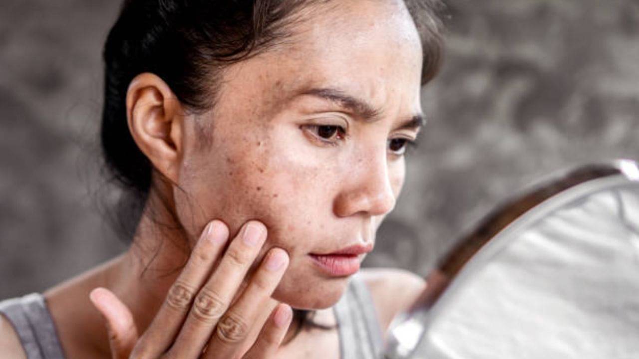 ঠোঁটের চারপাশে কালো ছোপ? যে ৪ টোটকায় কমবে মুখের ডার্ক স্পট