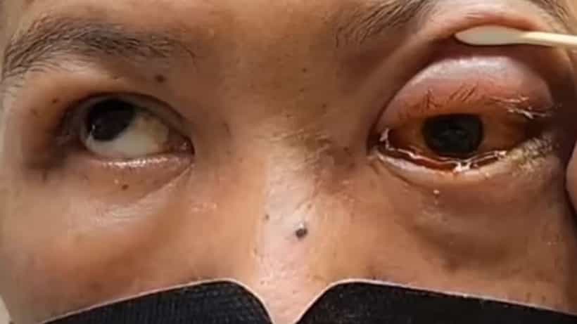 Eye paralyzed: মদ্যপানের পর মাথা নিচু করে ঘুমিয়েছিলেন, পরিণতি জানলে চমকে যাবেন
