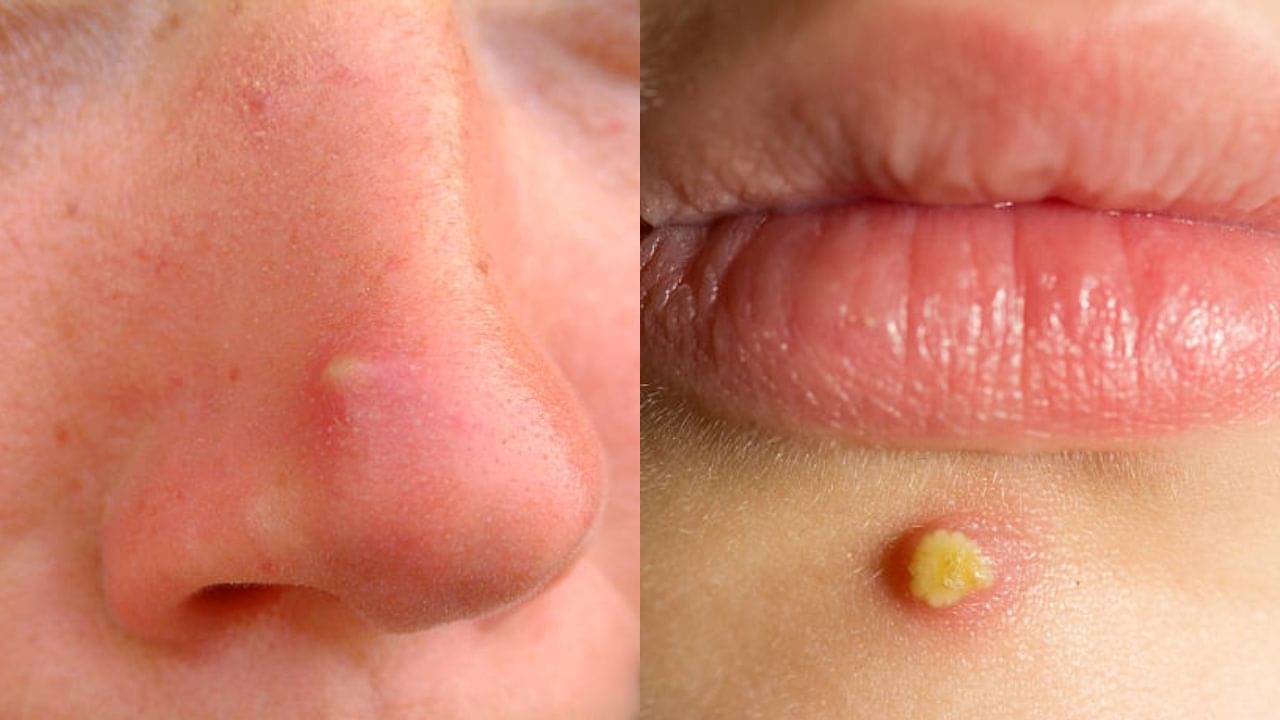 নাকের কোণে, ঠোঁটের নিচে হোয়াইটহেডসে ভরে গিয়েছে? না খুঁটে ঘরোয়া টোটকার সাহায্য নিন