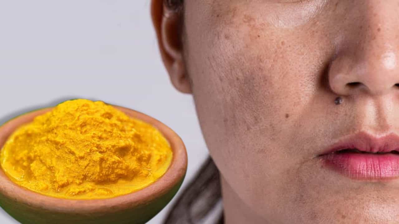 Hyperpigmentation: মুখের কালো দাগ-ছোপ থেকে মেচেতা এক সপ্তাহেই ফিকে হবে ঘরোয়া এই ফেসপ্যাকে Hyperpigmentation: মুখের কালো দাগ-ছোপ থেকে মেচেতা এক সপ্তাহেই ফিকে হবে ঘরোয়া এই ফেসপ্যাকে