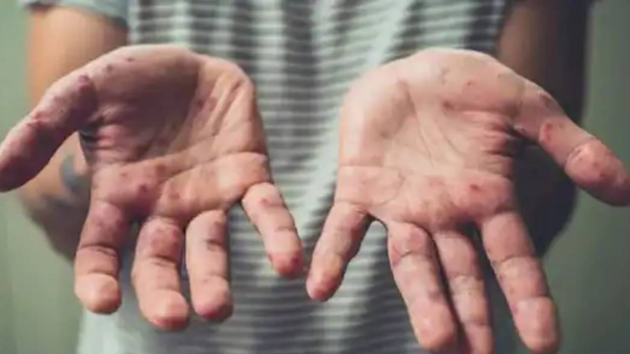 এই সময় সূতির পোশাক পরুন। নাহলে অস্বস্তি এবং চুলকানি দুইই বাড়বে। এদিকে সংক্রমণ এড়াতে প্রতিদিন দু’বেলা করে জামা-কাপড় বদলাতে ভুলবেন না যেন!