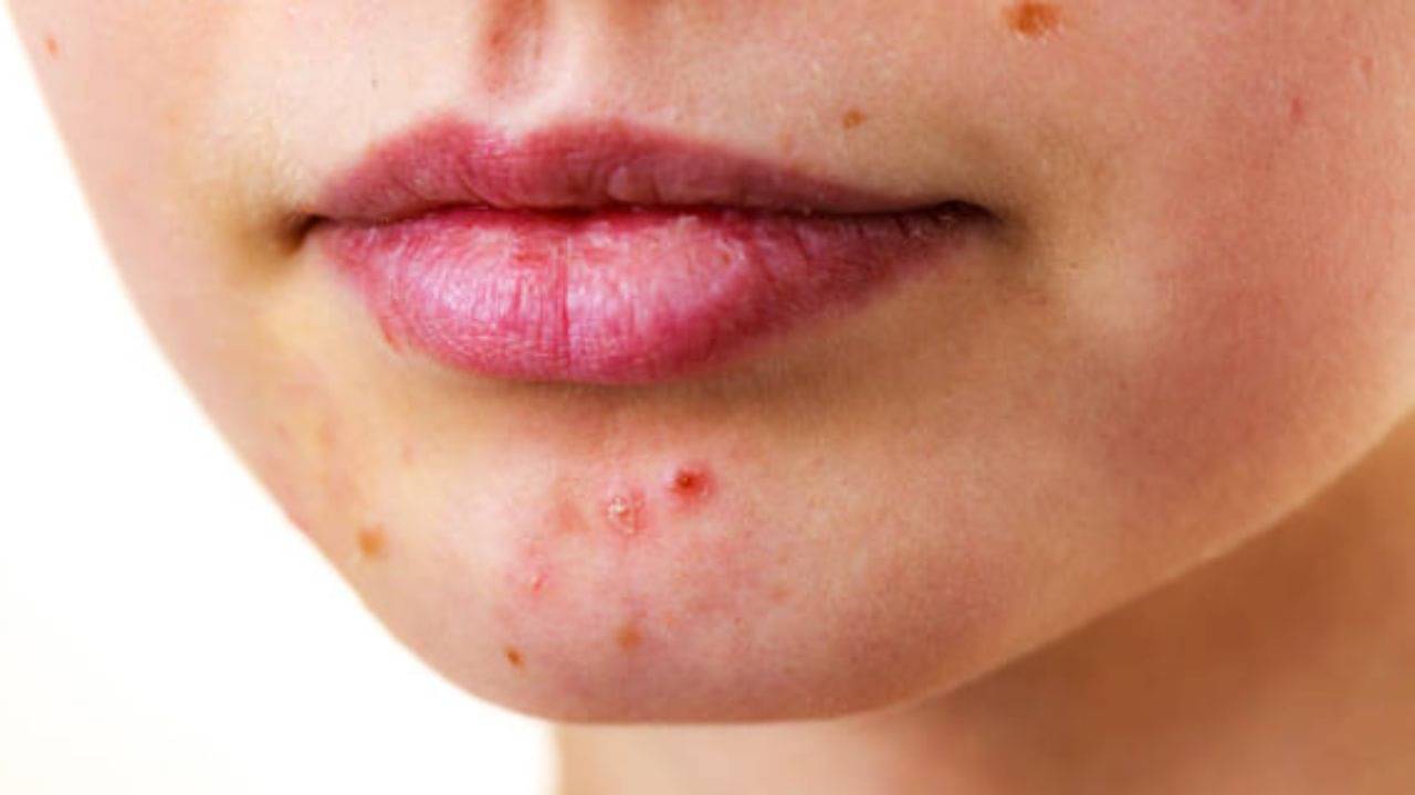 Acne: মুখের এই অংশের ব্রণ বলে দিতে পারে আপনার দেহে কোন অসুখ বাসা বেঁধেছে