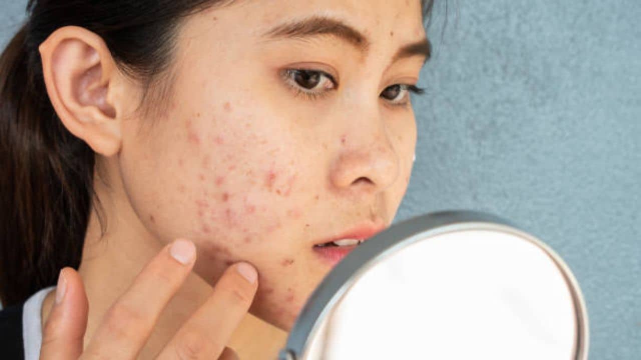 Spot Treatment: ব্রণ ভর্তি মুখ নিয়ে অস্বস্তির শেষ নেই? এক চিমটে হলুদেই হবে মুশকিল আসান