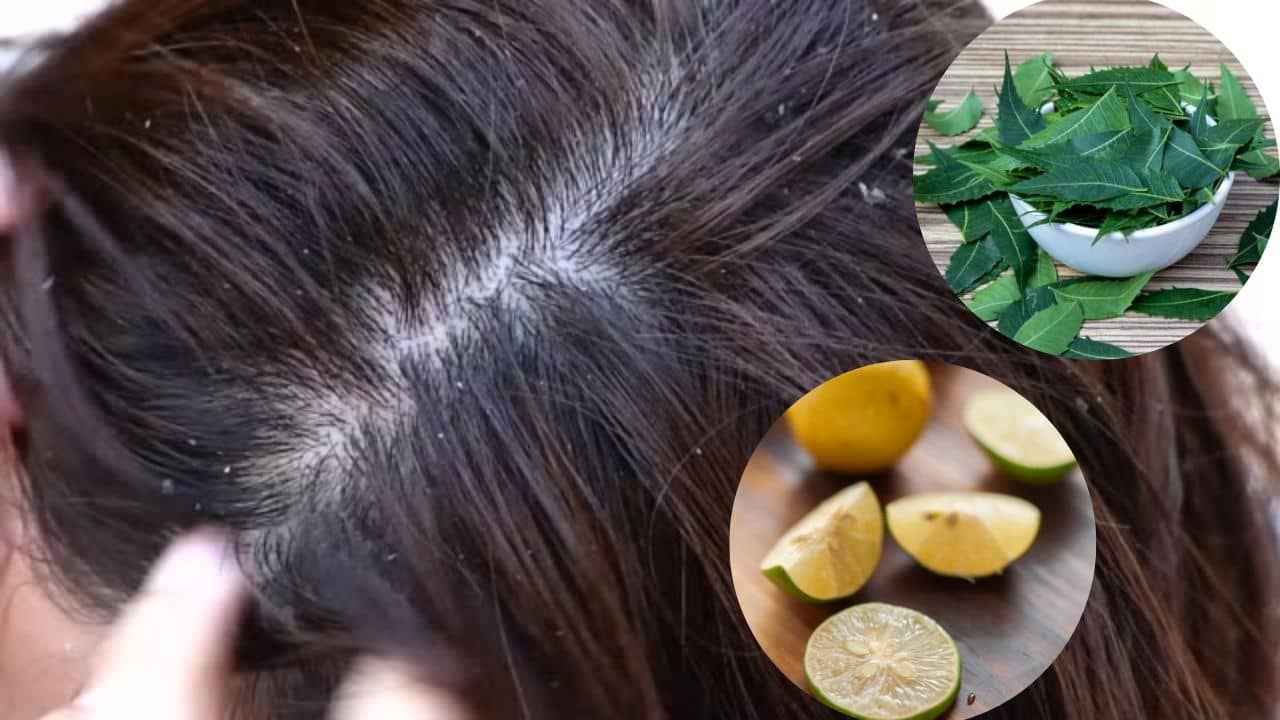 অ্যান্টি-ডানড্রফ শ্যাম্পু যখন ফেল, খুশকি তাড়াতে মাথায় মাখুন হেঁশেলের এই ২ উপাদান