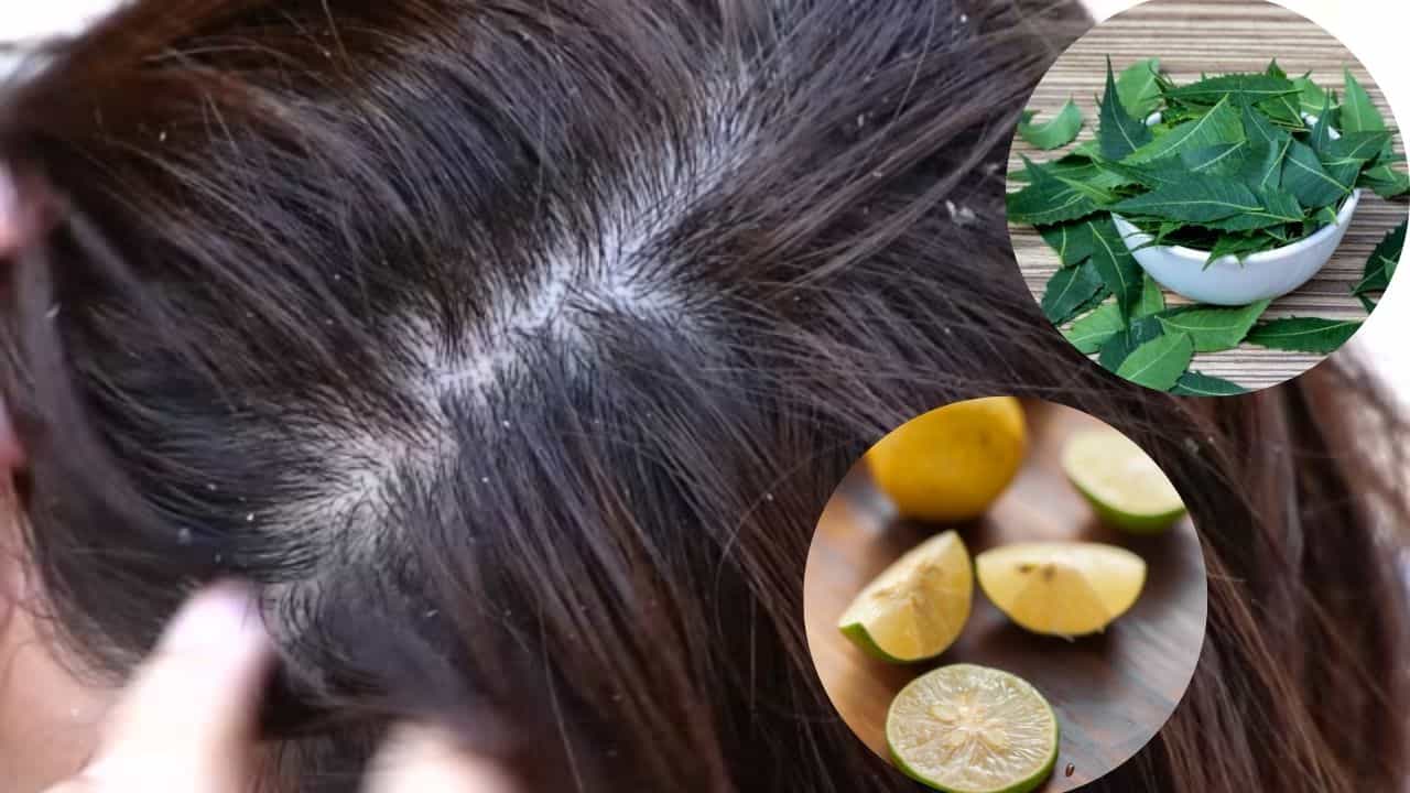 অ্যান্টি-ডানড্রফ শ্যাম্পু যখন ফেল, খুশকি তাড়াতে মাথায় মাখুন হেঁশেলের এই ২ উপাদান অ্যান্টি-ডানড্রফ শ্যাম্পু যখন ফেল, খুশকি তাড়াতে মাথায় মাখুন হেঁশেলের এই ২ উপাদান