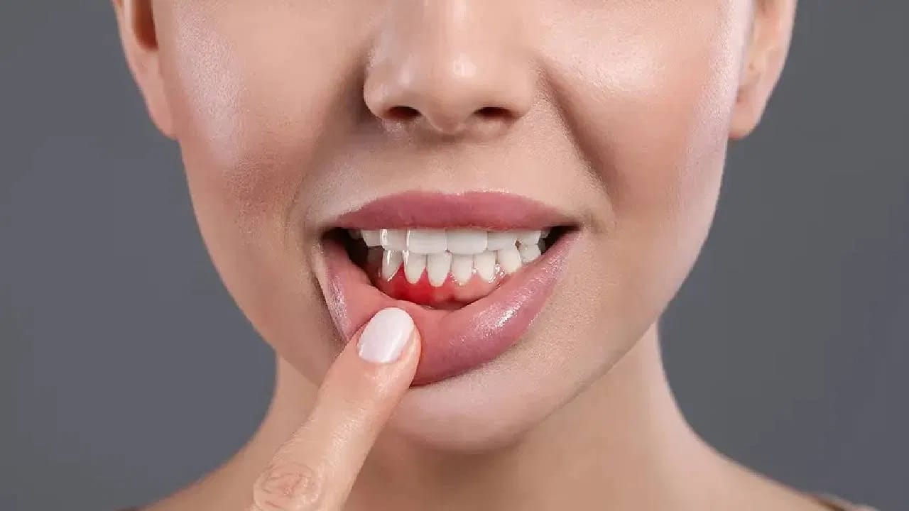 কিন্তু ব্রাশ করলেই দাঁত রক্ত ​​পড়তে থাকে। তাই আঙুলে মাজন নিয়ে আসতে করে দাঁতে বোলাতে থাকেন। আর এভাবে বেশ কয়েকদিন করেন।
