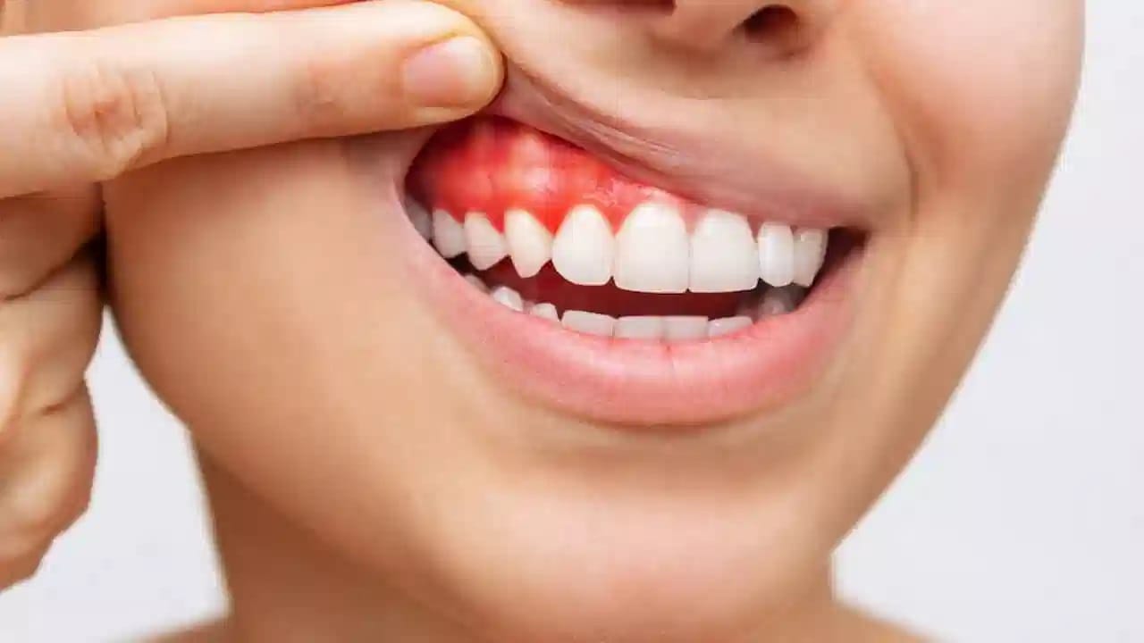ধূমপানও দাঁত থেকে রক্ত পড়ার একটি বিশেষ কারণ। দিনের পর দিন প্রচুর পরিমাণে ধূমপান করলে একটা সময় পর দাঁত ও মাড়ির উপর বিরাট প্রভাব পড়ে।