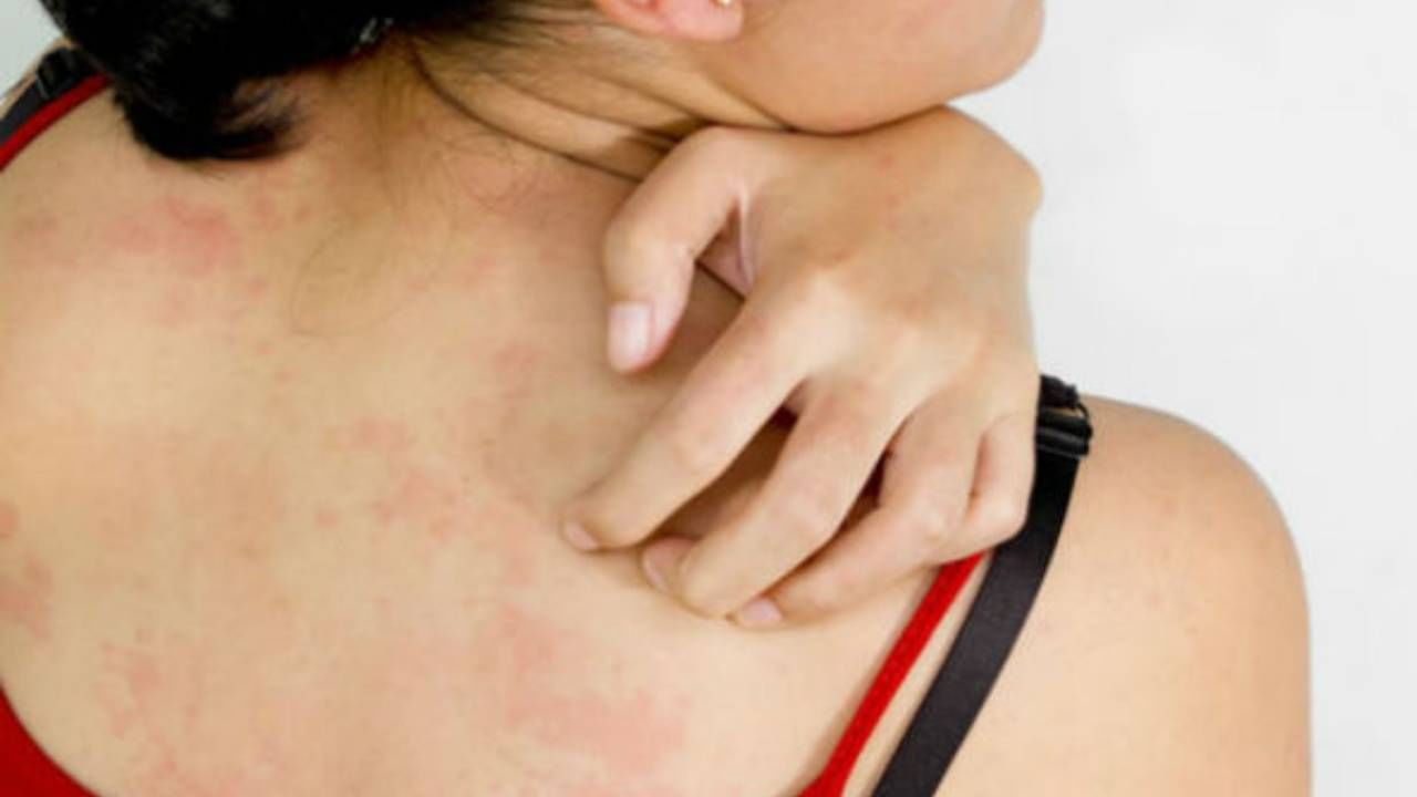 এই সময় রোগীর শরীর ঠান্ডা থাকা দরকার। তাই নিমপাতা ফুটিয়ে সেই জলে স্নান করলে উপকার পাবেন হাতেনাতে।