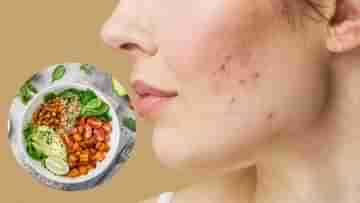 Anti-Acne Diet: গরমে বেশি তেল-মশলা খেলেই বাড়বে ব্রণ, কোন খাবারে পাবেন পরিষ্কার ত্বক?