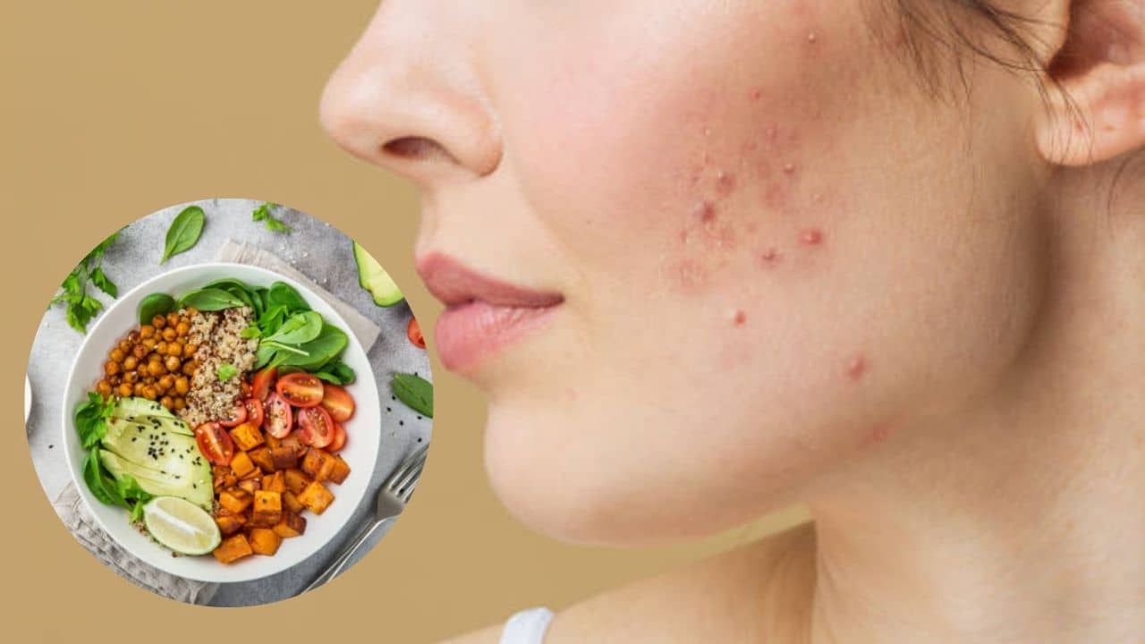 Anti-Acne Diet: গরমে বেশি তেল-মশলা খেলেই বাড়বে ব্রণ, কোন খাবারে পাবেন পরিষ্কার ত্বক?