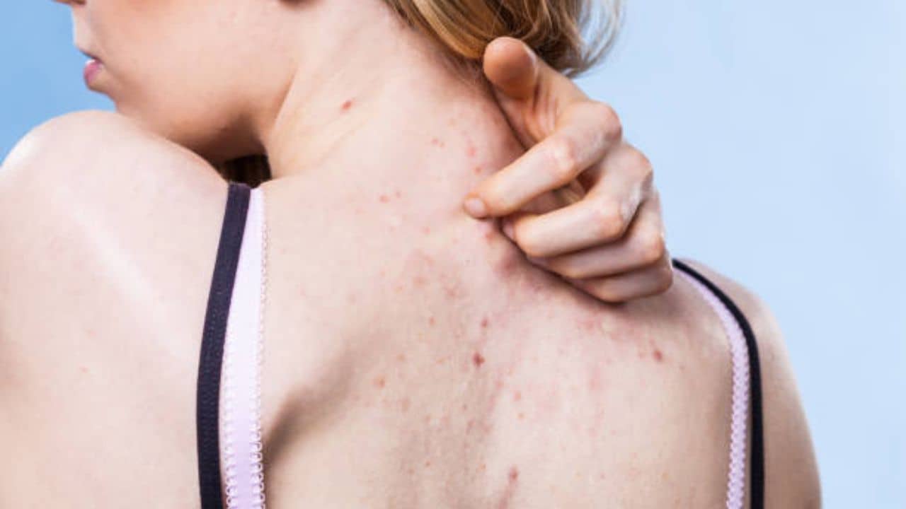 Summer Acne: মুখের পাশাপাশি গায়েও ব্রণ হচ্ছে? যে টোটকায় দূর করবেন গরমে পিম্পেলের সমস্যা