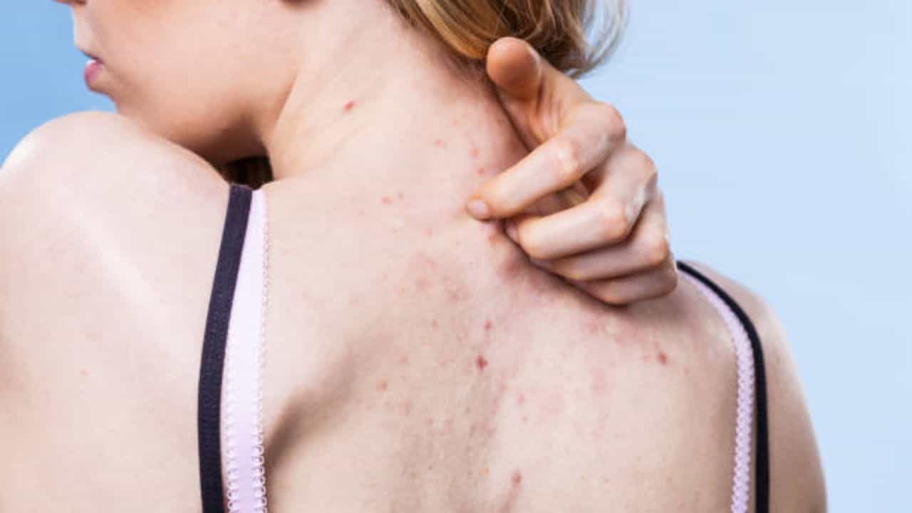Summer Acne: মুখের পাশাপাশি গায়েও ব্রণ হচ্ছে? যে টোটকায় দূর করবেন গরমে পিম্পেলের সমস্যা Summer Acne: মুখের পাশাপাশি গায়েও ব্রণ হচ্ছে? যে টোটকায় দূর করবেন গরমে পিম্পেলের সমস্যা