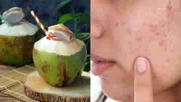 Coconut Water: সানবার্ন, ব্রণ, তৈলাক্ত ত্বকের জ্বালায় অস্থির? গরমে দুবেলা মুখে স্প্রে করুন ডাবের জল