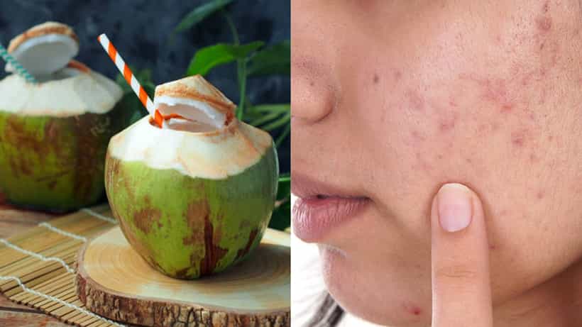 Coconut Water: সানবার্ন, ব্রণ, তৈলাক্ত ত্বকের জ্বালায় অস্থির? গরমে দুবেলা মুখে স্প্রে করুন ডাবের জল