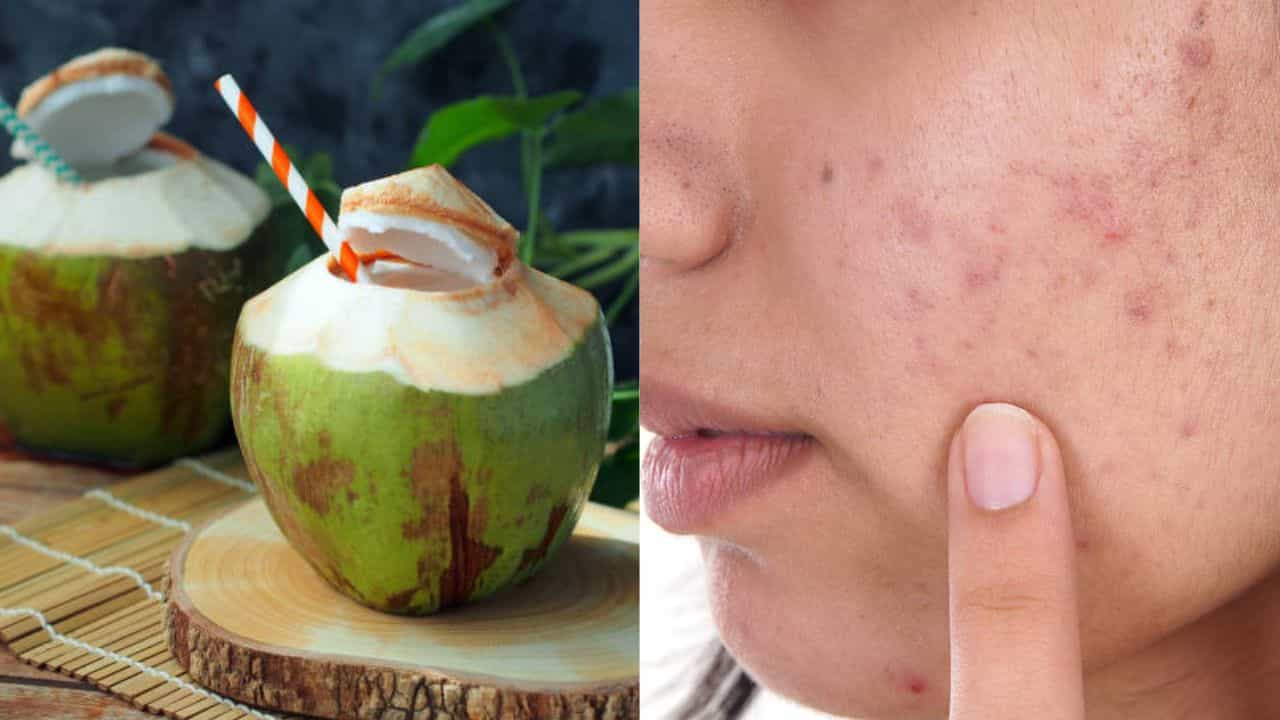 Coconut Water: সানবার্ন, ব্রণ, তৈলাক্ত ত্বকের জ্বালায় অস্থির? গরমে দু'বেলা মুখে স্প্রে করুন ডাবের জল Coconut Water: সানবার্ন, ব্রণ, তৈলাক্ত ত্বকের জ্বালায় অস্থির? গরমে দু'বেলা মুখে স্প্রে করুন ডাবের জল