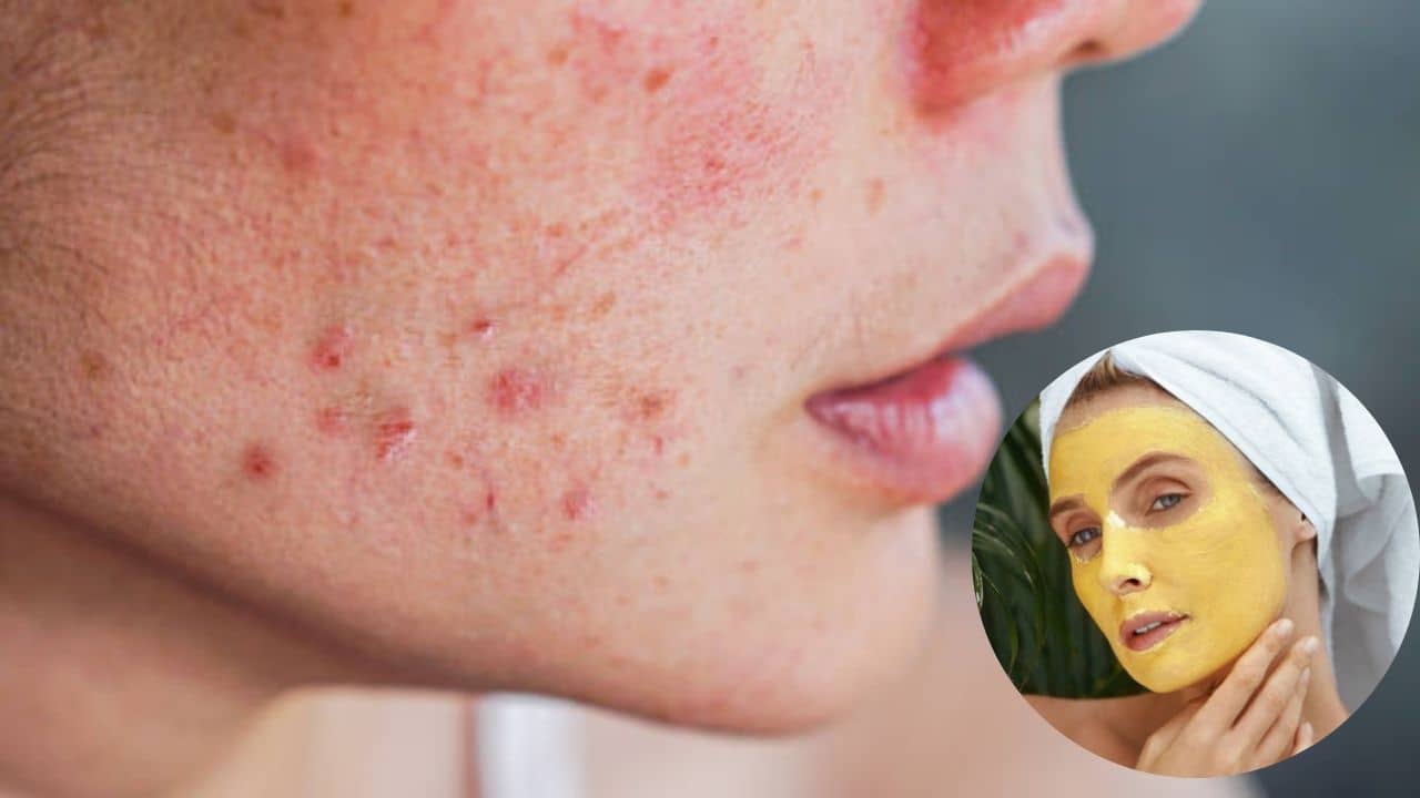 Summer Acne: গরম বাড়তেই ব্রণর বাড়বাড়ন্ত? যেভাবে যত্নআত্তি করবেন তেল ভরা মুখের