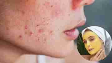 Summer Acne: গরম বাড়তেই ব্রণর বাড়বাড়ন্ত? যেভাবে যত্নআত্তি করবেন তেল ভরা মুখের