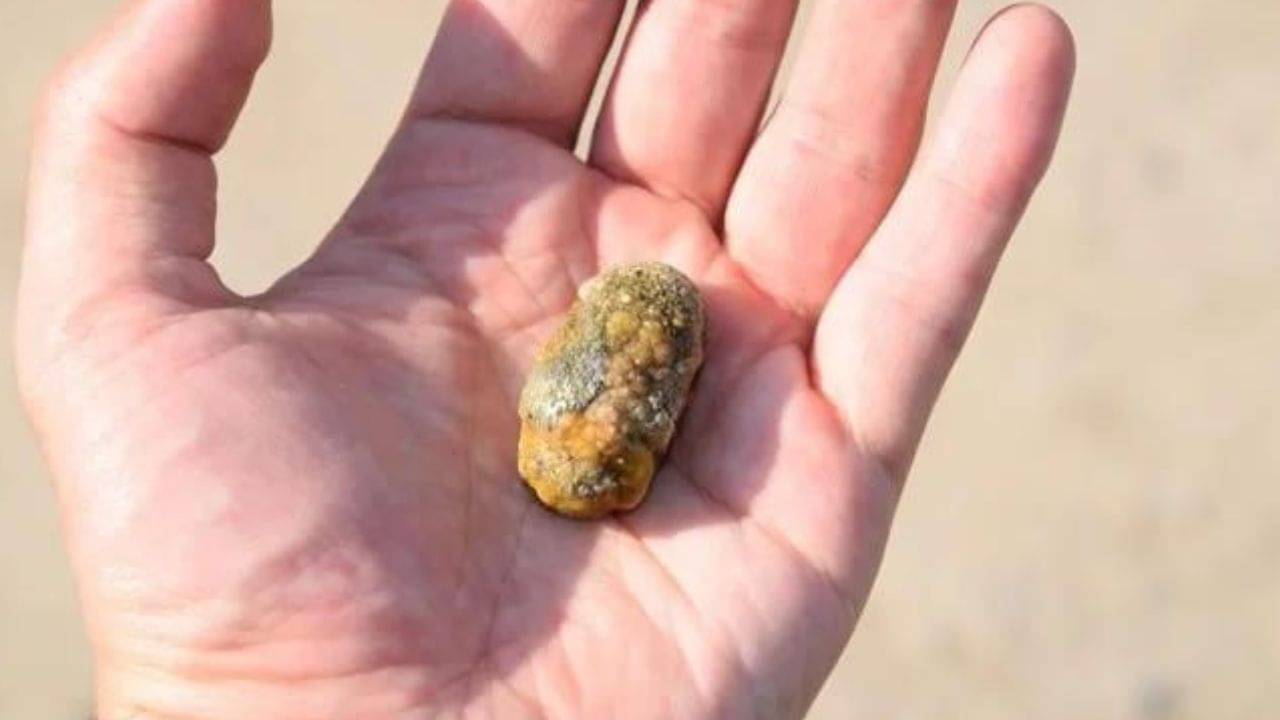 Gall Bladder Stone: গল ব্লাডার হলে কিংবা পিত্তথলিতে পাথর জমলে কী খাবেন, কেমনভাবে চলবেন?