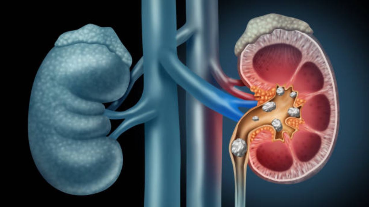 Kidney Stone: গরমে এই ৫ ডায়েট টিপস মানলে সহজেই কিডনির পাথর বেরিয়ে যাবে শরীর থেকে
