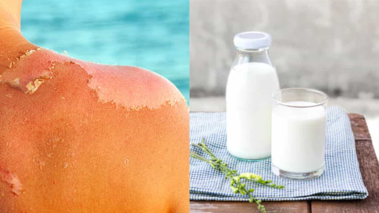Sunburn Home Remedy: কাঠফাটা রোদে ত্বক পুড়ে গিয়েছে, ঠান্ডা দুধ লাগালে কি সানবার্নের জ্বালা কমবে? Sunburn Home Remedy: কাঠফাটা রোদে ত্বক পুড়ে গিয়েছে, ঠান্ডা দুধ লাগালে কি সানবার্নের জ্বালা কমবে?